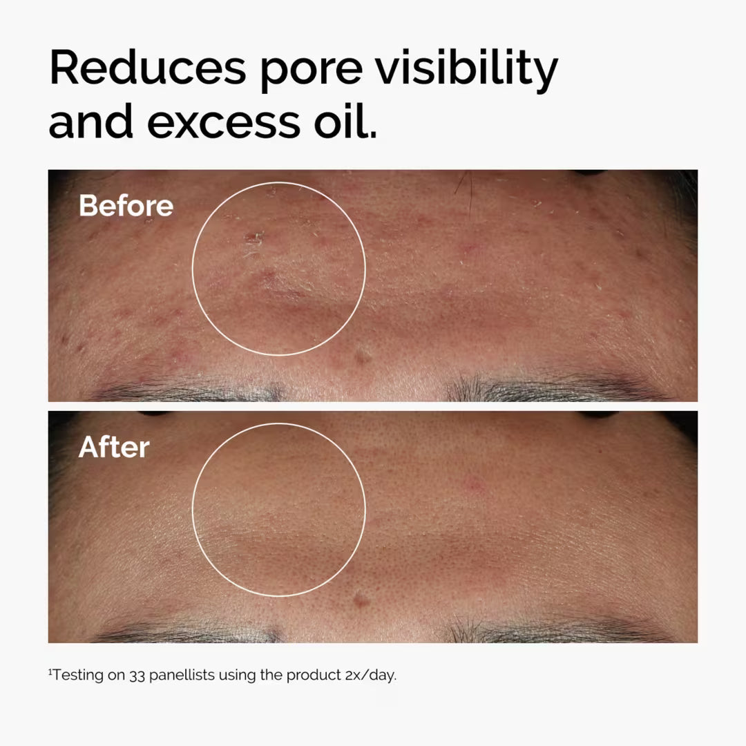 Oily Face Serum